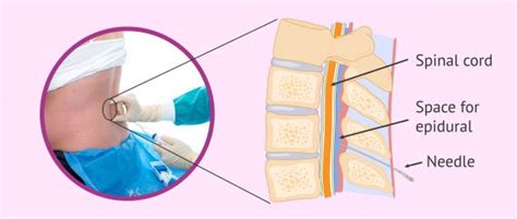 epidurium|Epidural For Labor: Epidural Side Effects, Benefits & Safety.